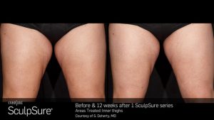 Before and After Photos of SculpSure