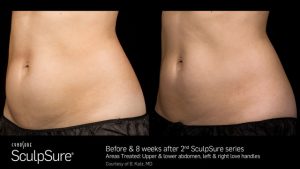 Before and After Photos of SculpSure
