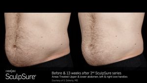 Before and After Photos of SculpSure for Men