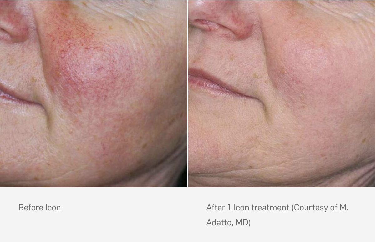 Before and after Icon treatments