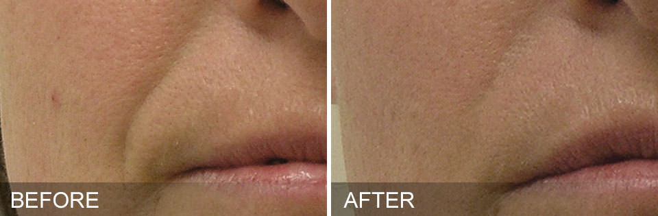 Before and after HydraFacial