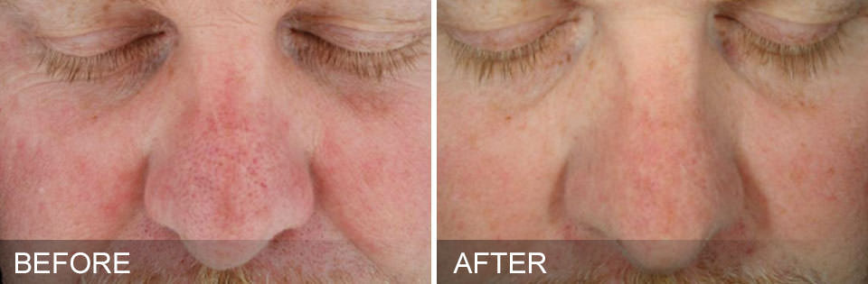 Before and after HydraFacial