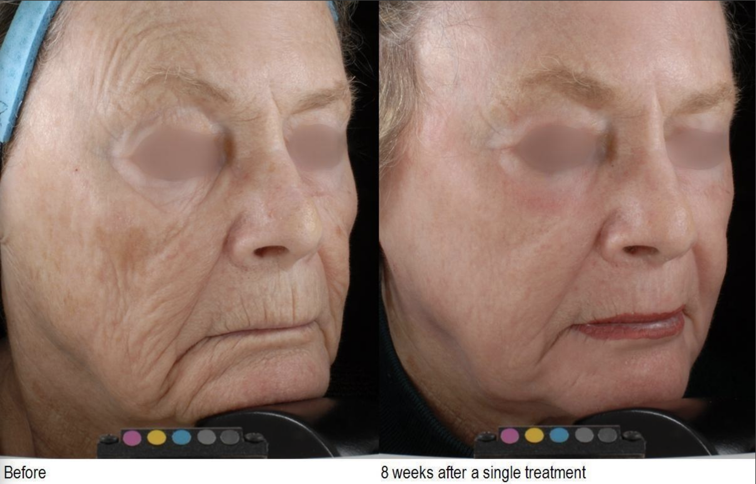 Before and after photos for the Facial CO2 laser