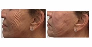 Before and after photos for the Facial CO2 laser