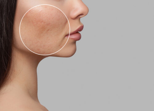 Microneedling